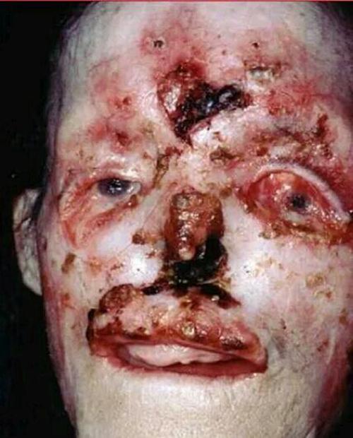 早期妊娠合并梅毒图片