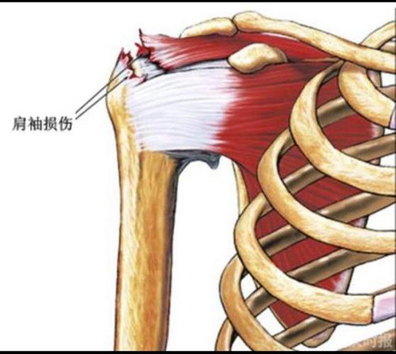 可能是肩锁关节损伤, ,肩膀前内侧喙突的位置疼痛, 可能是胸小肌或者