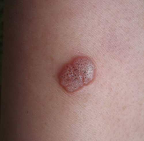 儿童也会感染"人乳头瘤病毒"(hpv)吗?