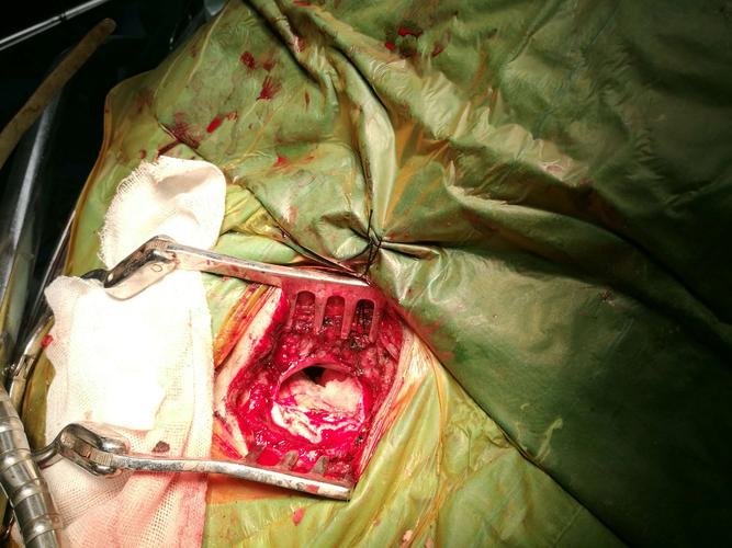 成功切除一例听神经瘤