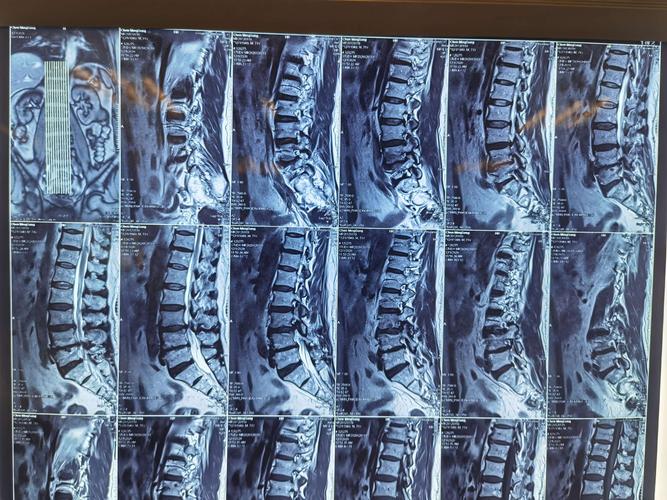 二骨二区,37床,陈明松,男,71岁,腰椎管狭窄,腰椎间盘突出(l3/4,l4/5)