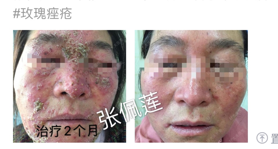 玫瑰痤疮的治疗