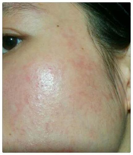 激素依赖性皮炎症状为什么反复冒疹子,是排毒吗?