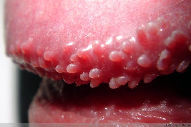 男性冠状沟红肿是什么病