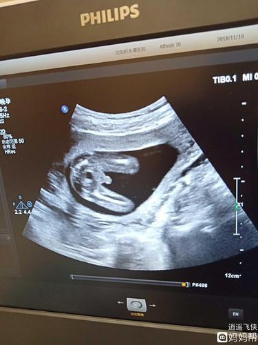 帮我看看是男宝女宝,上边的是四维.下边图片是怀孕期四个多月的照片.