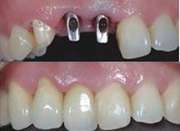 真人案例 牙齿种植案例