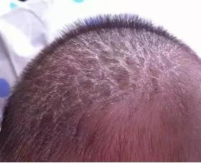 如果乳痂十分顽固,可以用同 新生宝贝头垢的成因是受母体残留激素的