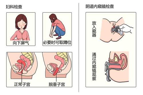 如何判断子宫脱垂