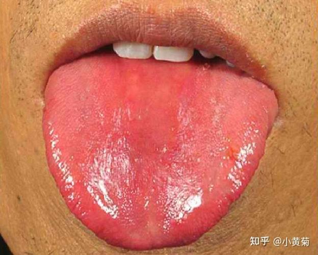 光红舌舌象