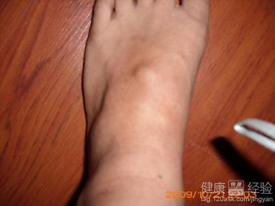 足背有腱鞘囊肿怎么办