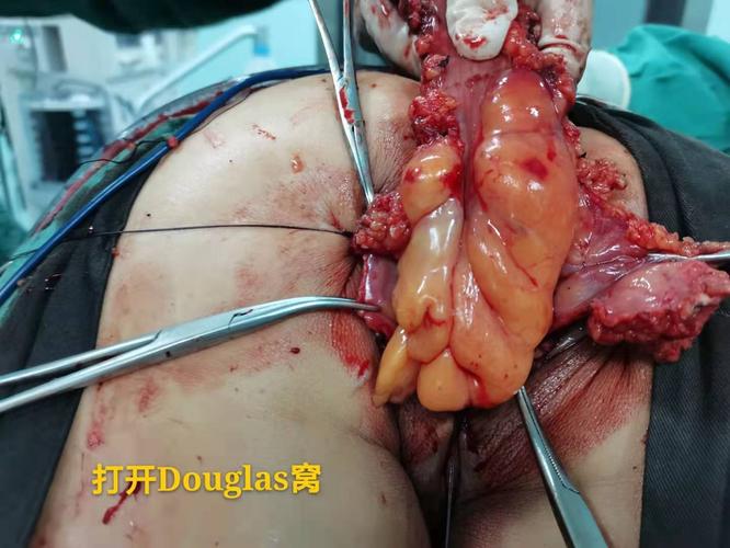 附属南华医院肛肠科 写美篇 病例简介:患者:阳某,女,47岁,湖南衡阳人