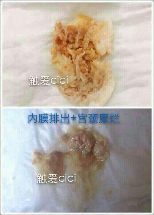 图片有点恶心 先看下宫颈糜烂排出物