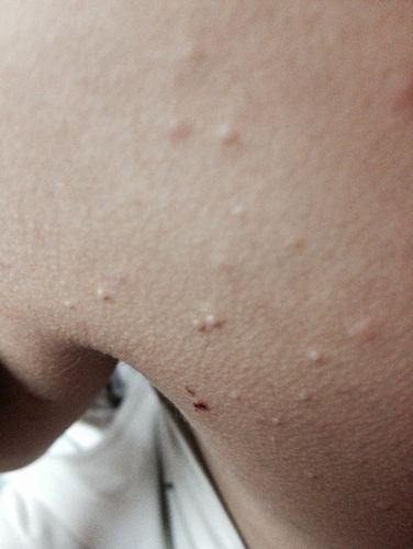 宝宝差3个月3周岁背部 胸部 大腿根部长了一片片的白色的疙瘩