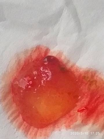 这个是孕囊吗?自己掉出来了,是生化了还是自然流产了