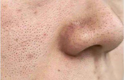 脸上螨虫超标时,会有4个迹象非常明显,教你3招螨虫阵亡