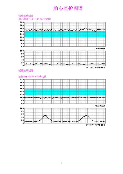 胎心监护图谱.doc