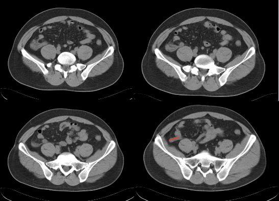 ct片上总是找不到阑尾3步法教你快速定位
