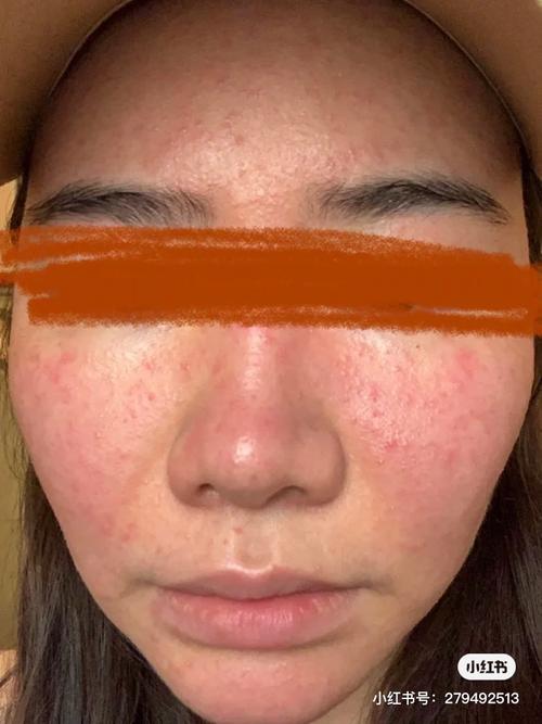 玫瑰座疮炎症丘疹(毛囊虫感染)