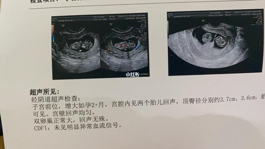 11周的宝宝 好可爱呀 孕囊变成胎儿了_胎儿_孕囊_孕期