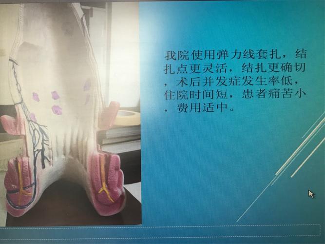 外科近几年开展痔疮微创治疗新技术——自动弹力线痔疮套扎术(rph-4)