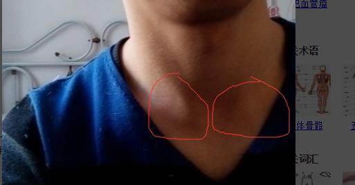 请问这个地方有淋巴结吗?我圈出的两个"肿块"是由于我