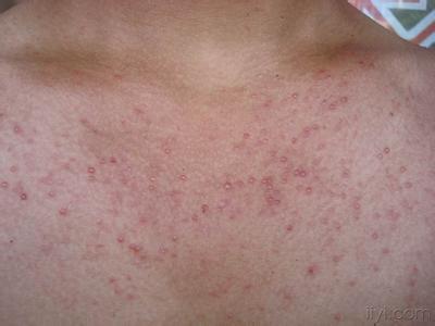 生活中导致毛囊炎发生的原因有很多,在患有毛囊炎时,表现为红色丘疹