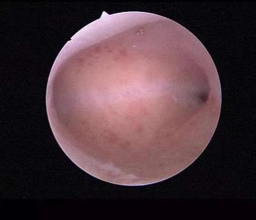 正常子宫内膜平整的