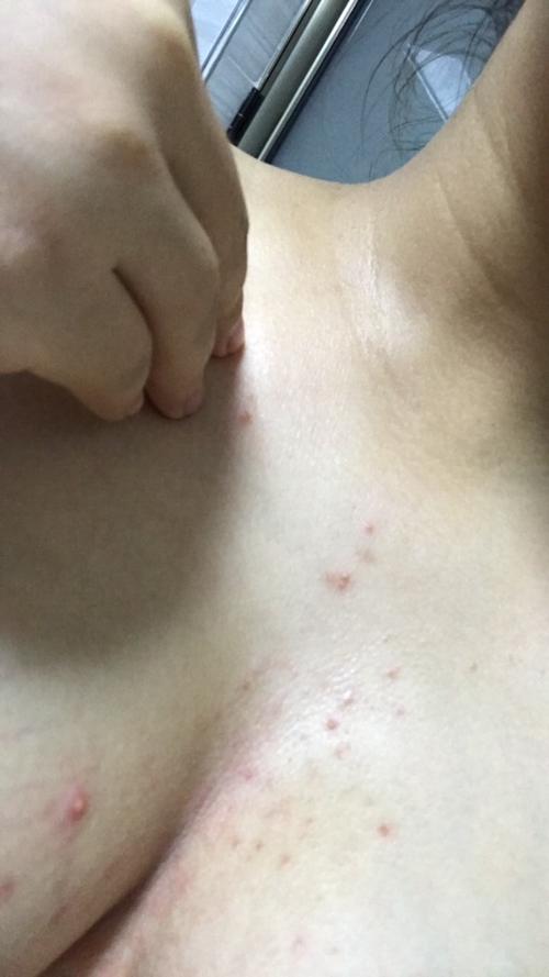 胸部长好多痘痘