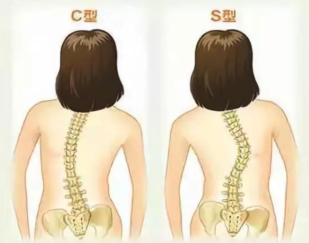 驼背产生的原因有哪些?