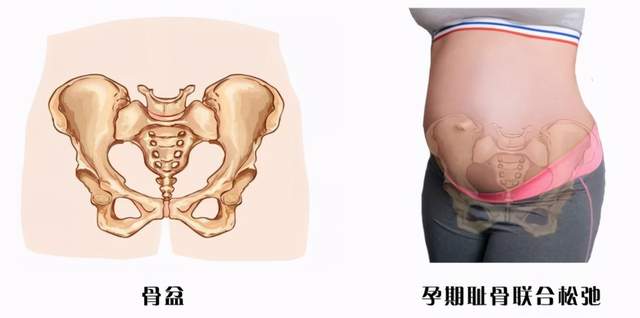 怀孕生孩子那些事 之 耻骨联合分离,为什么会耻骨分离