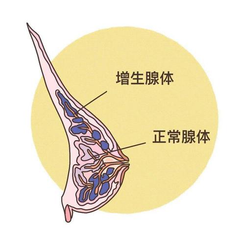 引起的乳腺腺体增大,增生而是内分泌激素失调它既不是肿瘤,也不是炎症
