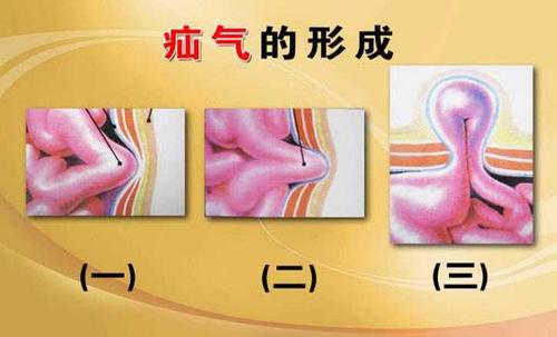 疝气只是小男孩得的病疝气有很多种老人也不要忽略