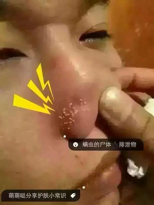 我前几天去美容院去黑头 现在鼻子怎么这么乌黑?