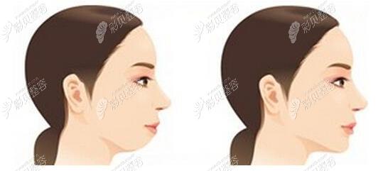兰州做面部抽脂比较好的正规医院吸脂去双下巴大概多少钱