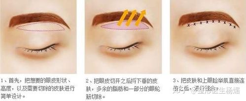 一般来说,眉下切口比较常见,不会改变眉形不需要重新纹眉 眉下切口