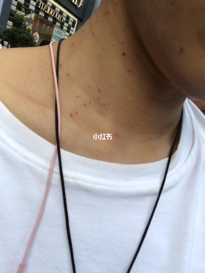 脖子上一粒粒的,还以为是角质,发照片给护士,就是图一,说我还有丝状疣