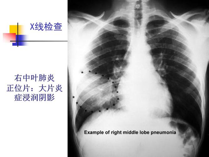 肺部感染性疾病.
