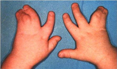 南医大宋教授解析:多并指该如何治疗?