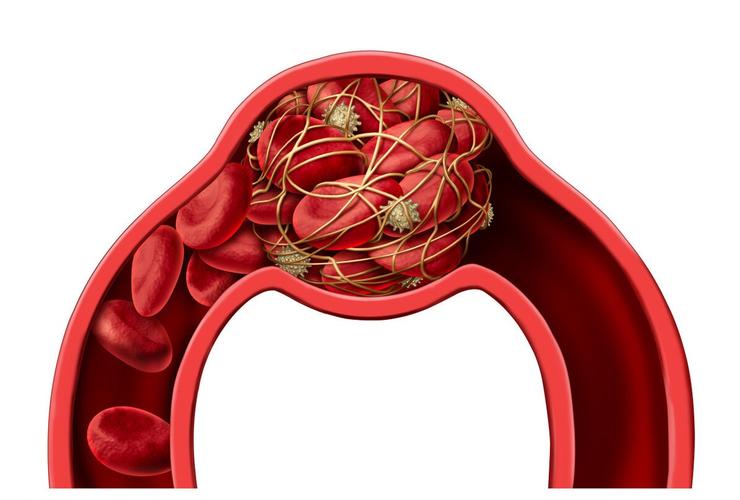 在患有房颤时,以及下肢静脉血栓,形成的就是"红色血栓".