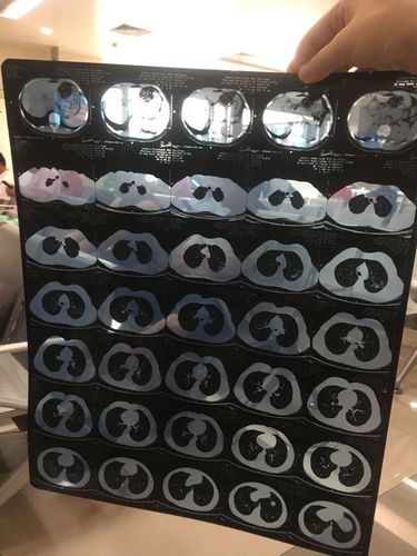 我今年26岁女,身体无任何异常,体检发现左肺有模糊阴影,然后我去医院