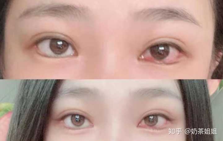 开外眼角有什么不好吗?