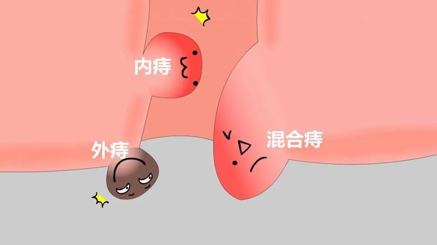 静脉曲张性外痔