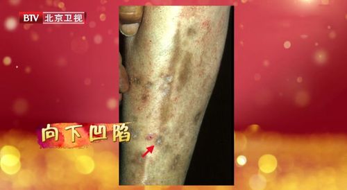 腿上有这种斑,当心糖尿病胫前色素斑!保护腿足,这些方法很实用