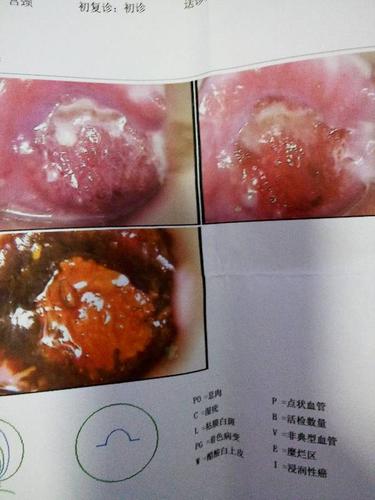 这个图片宫颈糜烂严重吗?我才21岁,要动手术吗?