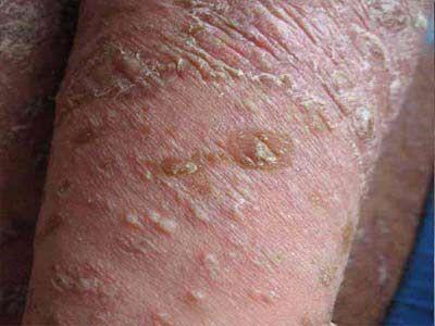 发病的人群很广泛,儿童也是发病人群的一种,那么儿童脸上有干癣怎么办