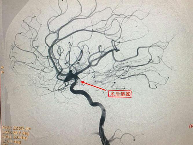 我院成功实施首例全脑血管造影动脉瘤栓塞手术