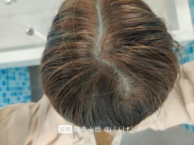 后脑勺那不知道是不是发旋 头发看起来好少