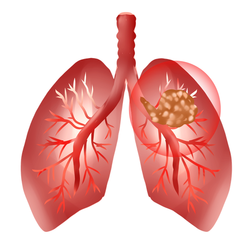 不敢直视的体检报告肺小结节