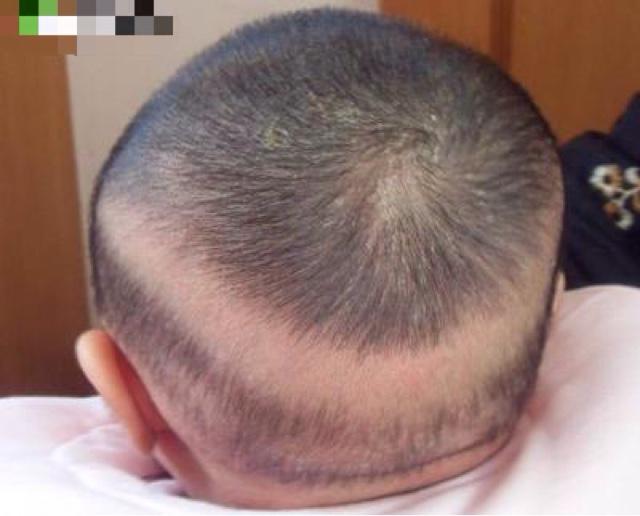          六,出现枕秃(钙圈)  不