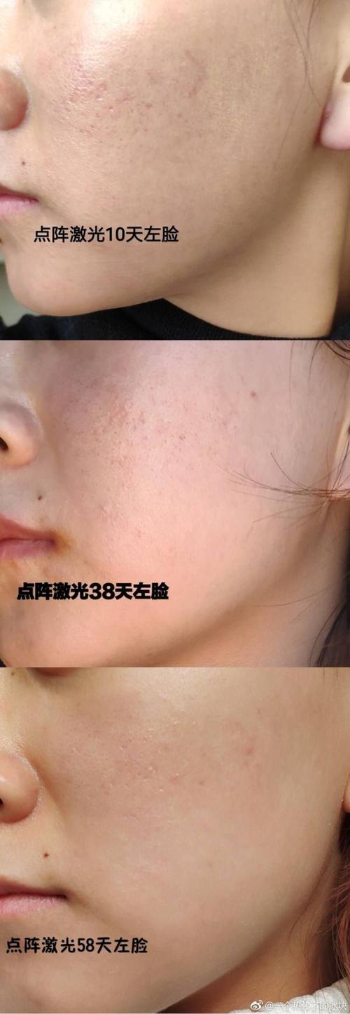 点阵激光去痘坑的效果如何?